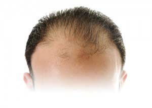 Hair transplant pozitív visszajelzésekkel